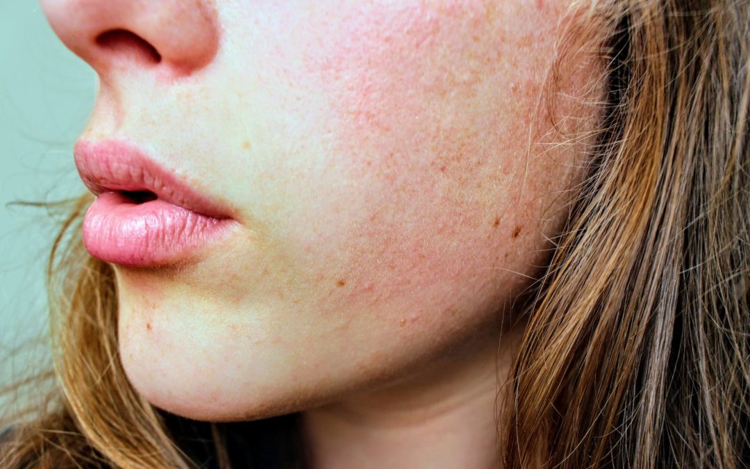 Conquistar Monarquía Guia Rutina para cuidar la piel grasa o con acné de forma natural | Blog Adonia  Cosmética natural