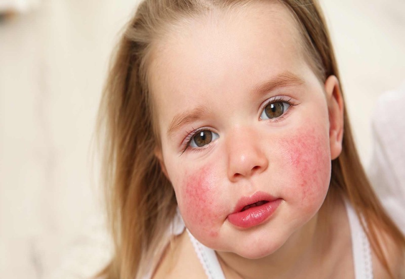 Dermatitis infantiles. Cómo prevenir - BLOG DE COSMETICA NATURAL